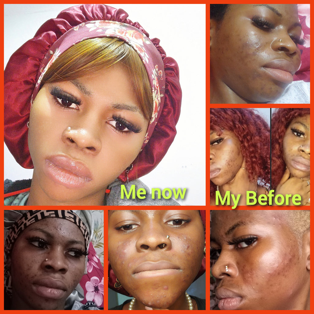 Maonas Mini Pimples Treatment Combo