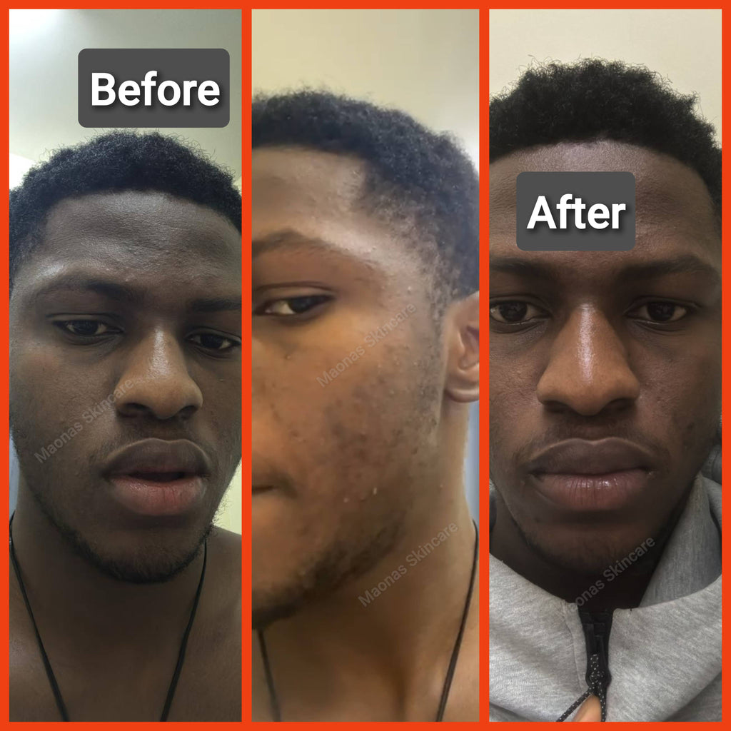 Maonas Mini Pimples Treatment Combo