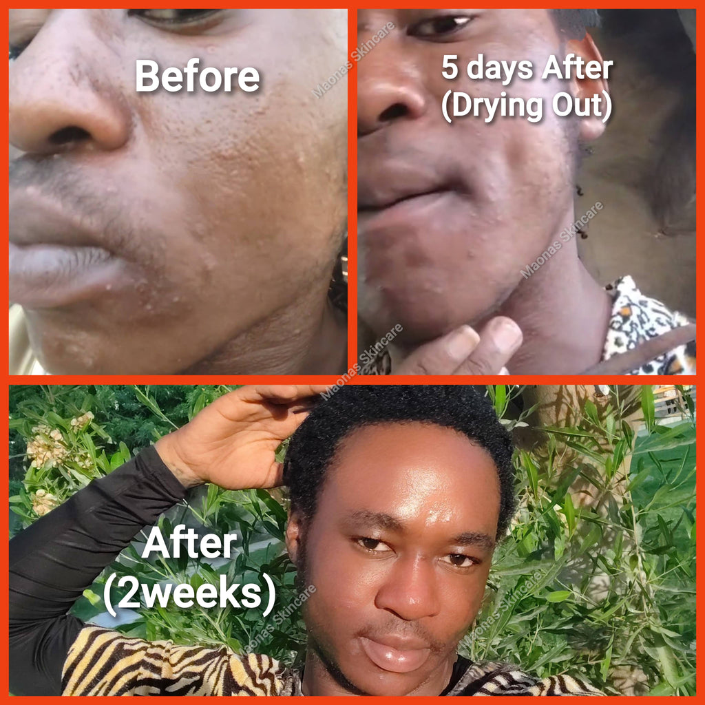 Maonas Mini Pimples Treatment Combo