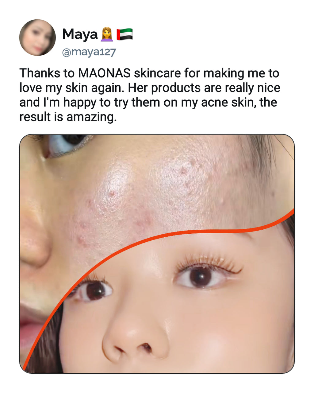 Maonas Mini Pimples Treatment Combo